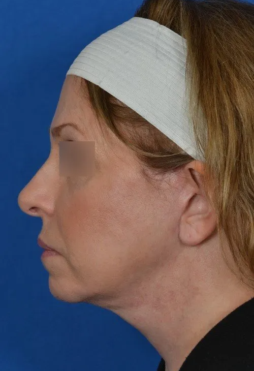 female facelift