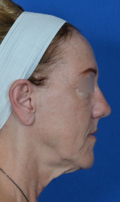 mini facelift before and after