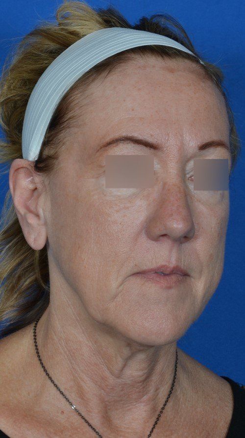 mini facelift before and after