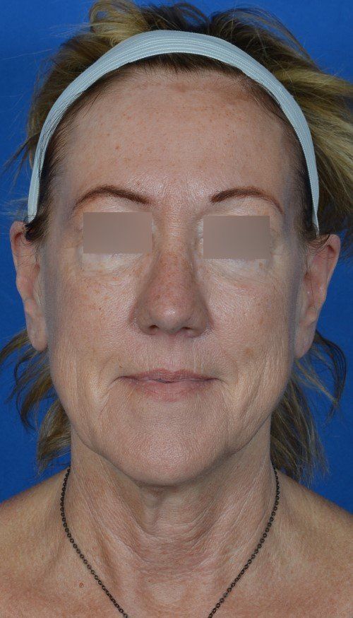 mini facelift before and after