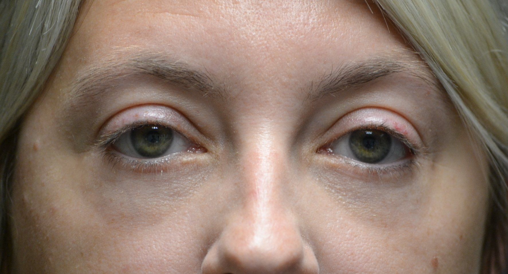 blepharoplasty before and after