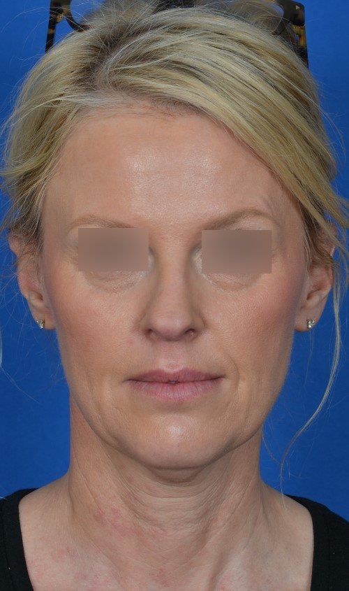mini facelift before and after