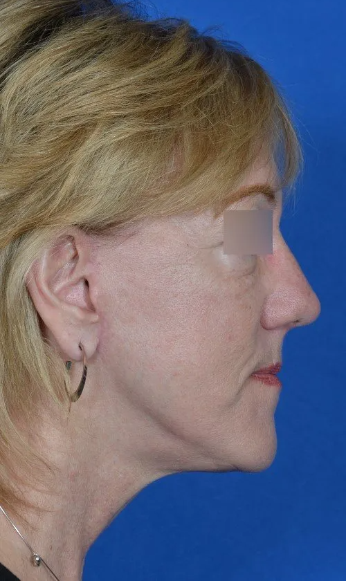 mini facelift before and after
