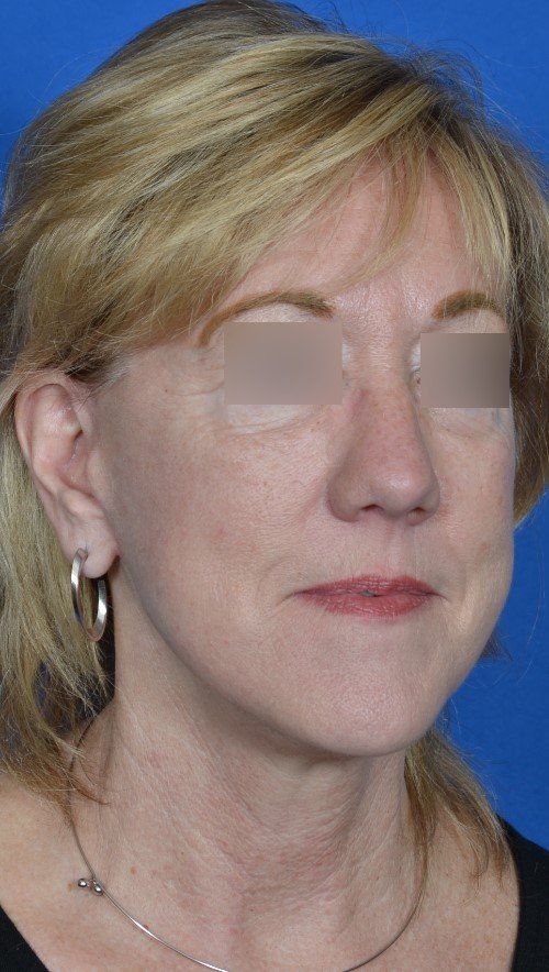 mini facelift before and after