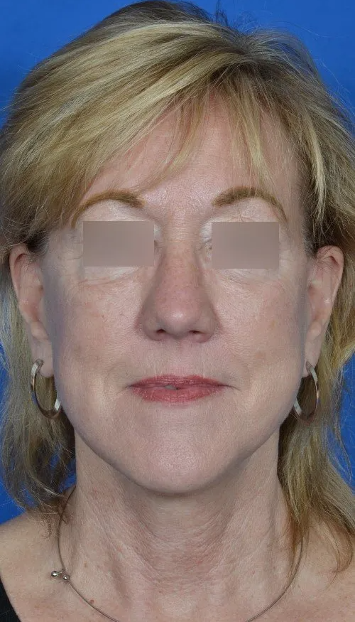 mini facelift before and after