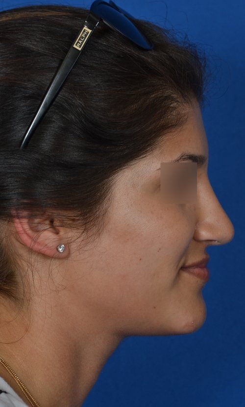 rhinoplasty