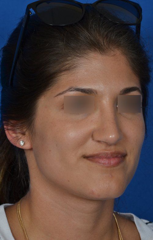 female rhinoplasty