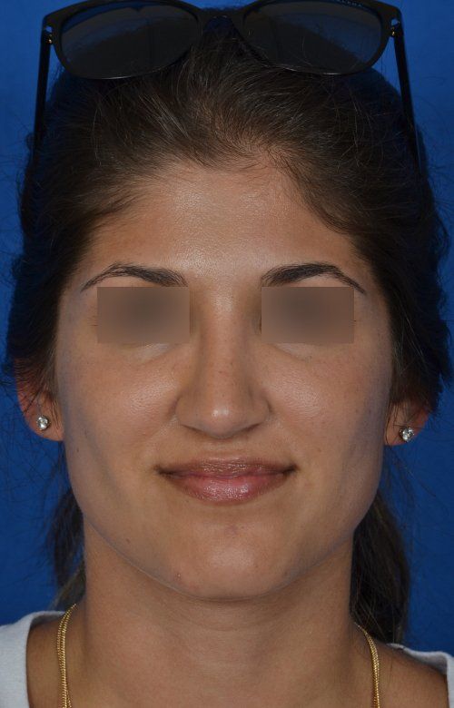 female rhinoplasty