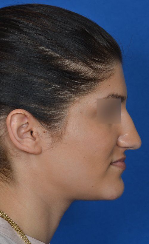 rhinoplasty