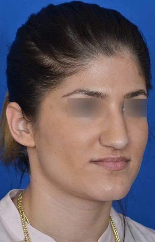 female rhinoplasty