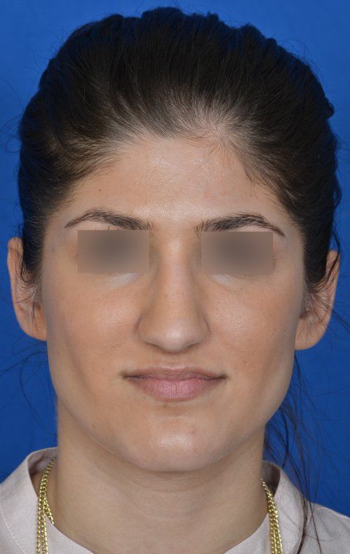 female rhinoplasty