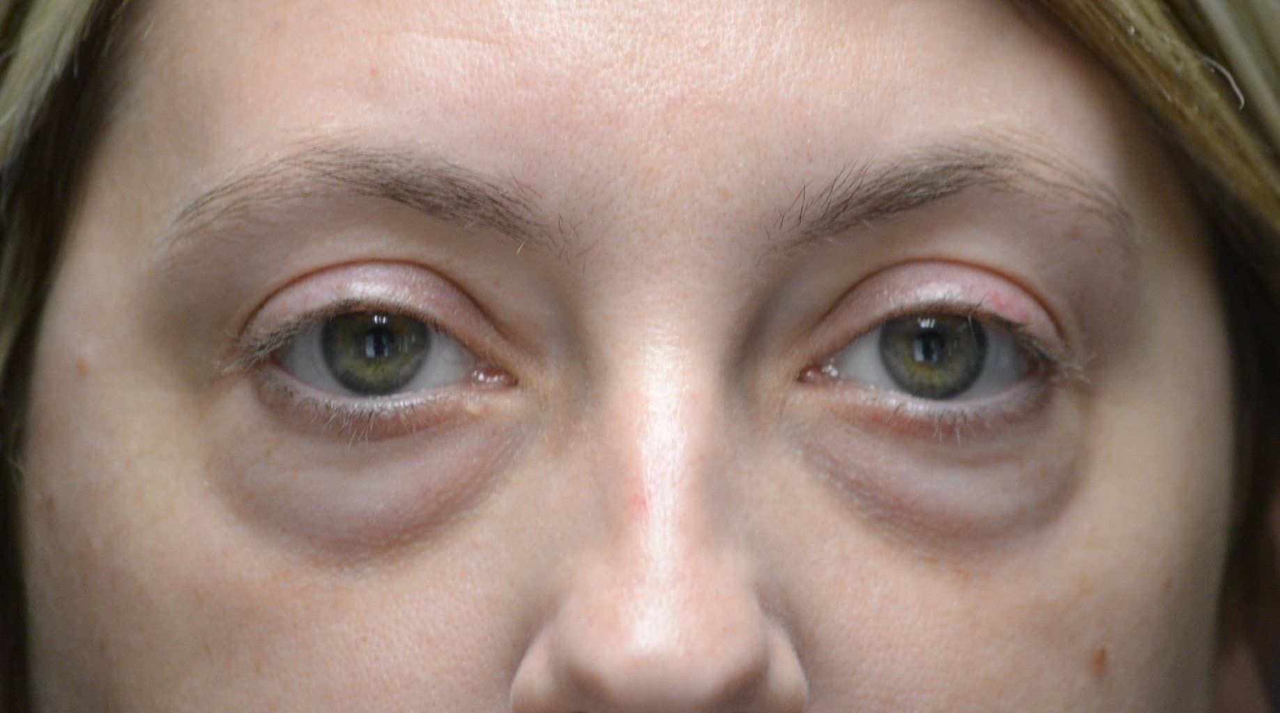 blepharoplasty before and after