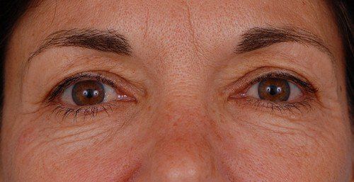 blepharoplasty before and after