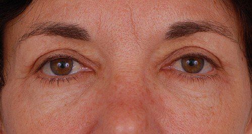 blepharoplasty before and after