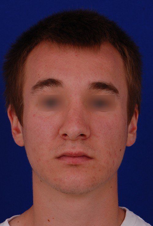 male rhinoplasty