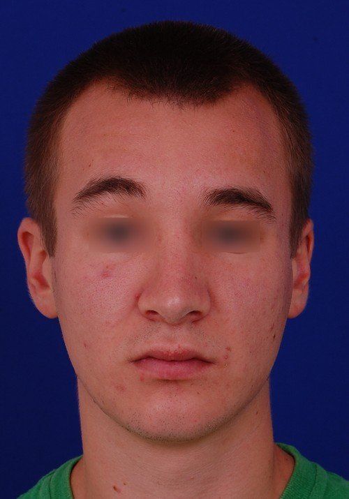 male rhinoplasty after