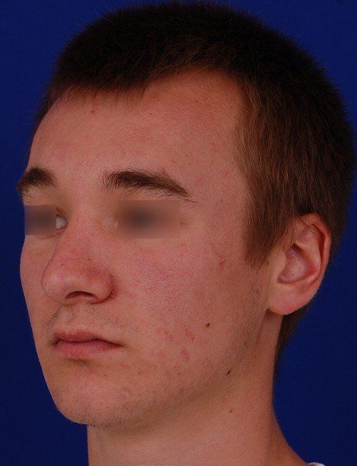 male rhinoplasty