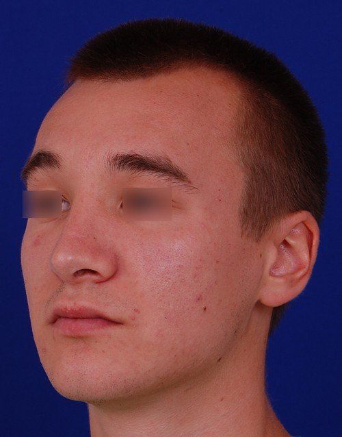 male rhinoplasty after