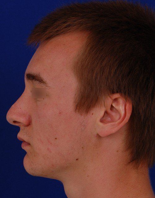 male rhinoplasty