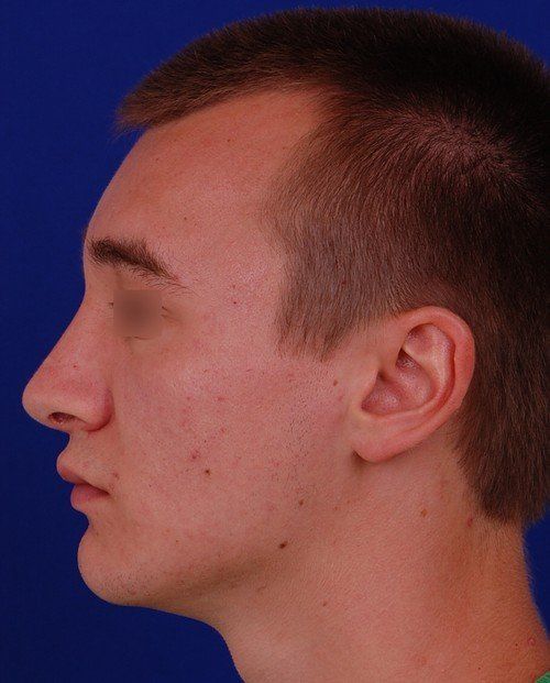 male rhinoplasty after