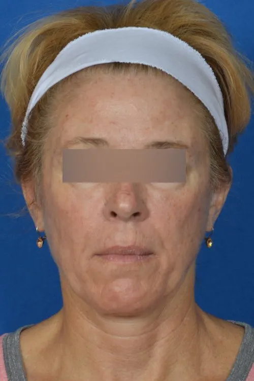 mini facelift before and after
