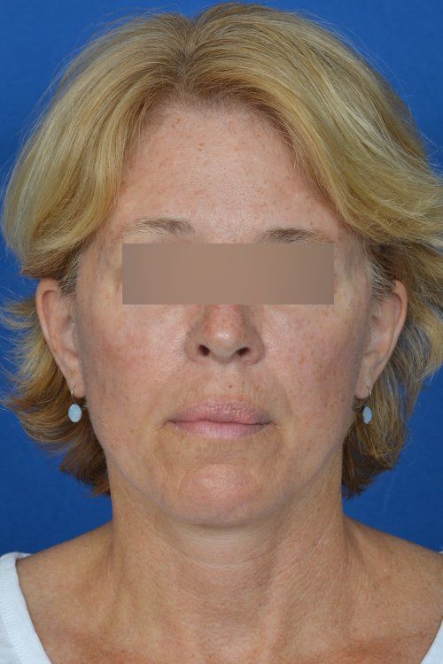 mini facelift before and after