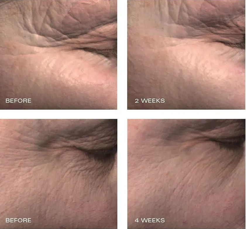 wrinkles before and after using growth factor serum