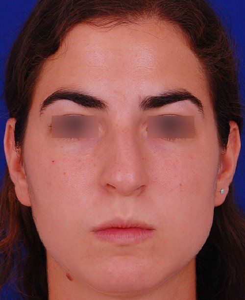 rhinoplasty