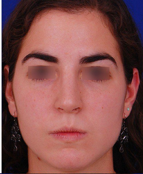 rhinoplasty