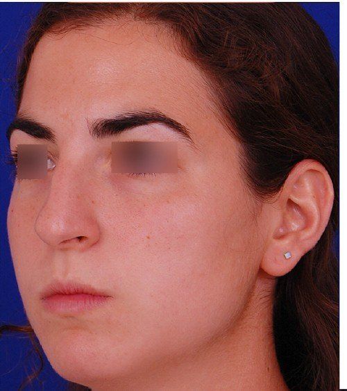 rhinoplasty
