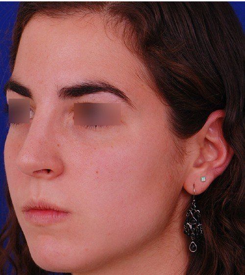 female rhinoplasty