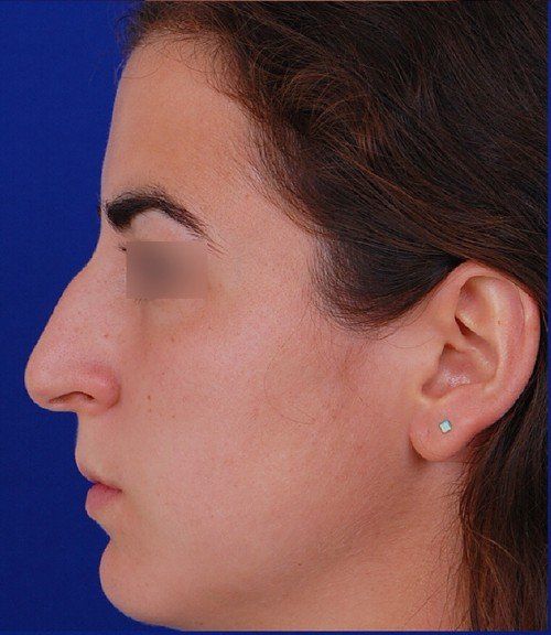female rhinoplasty