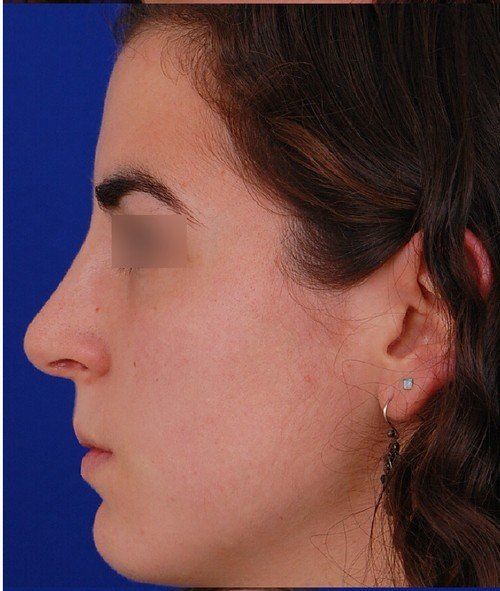 female rhinoplasty