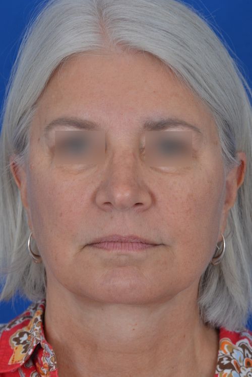 mini facelift before and after