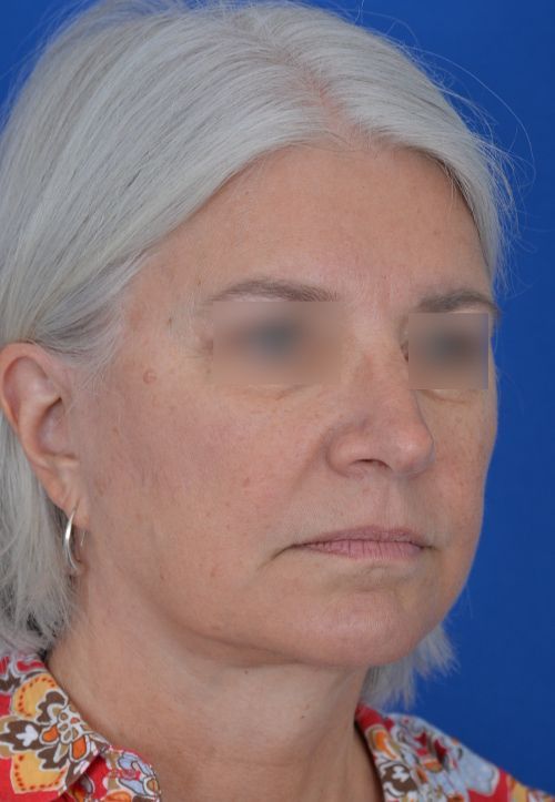 mini facelift before and after