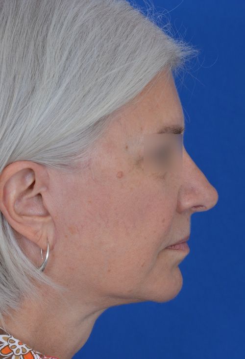 mini facelift before and after