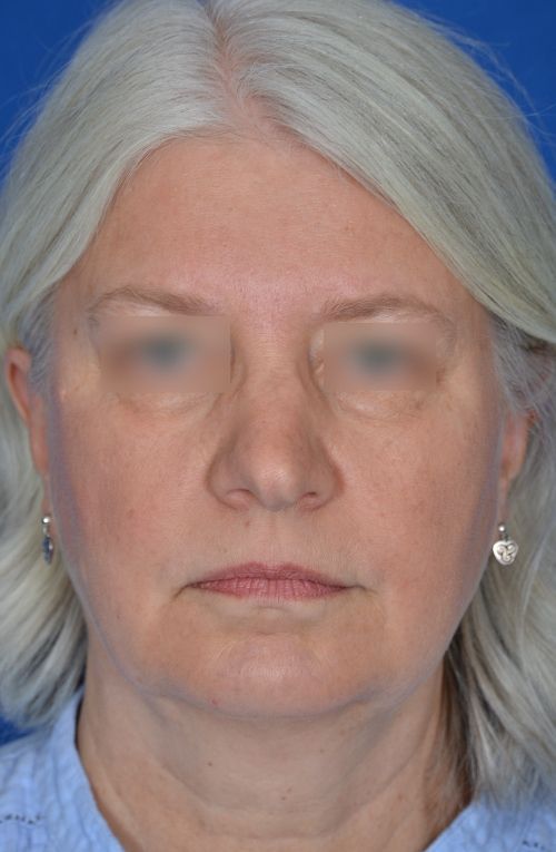 mini facelift before and after