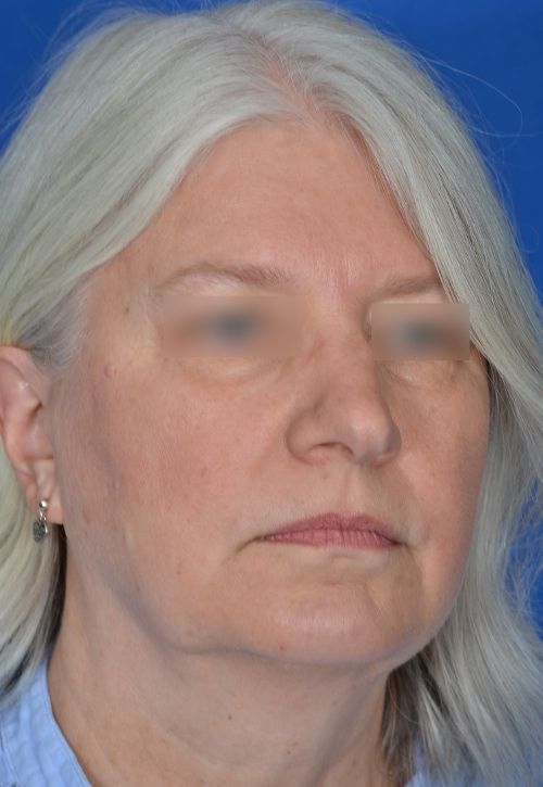 mini facelift before and after