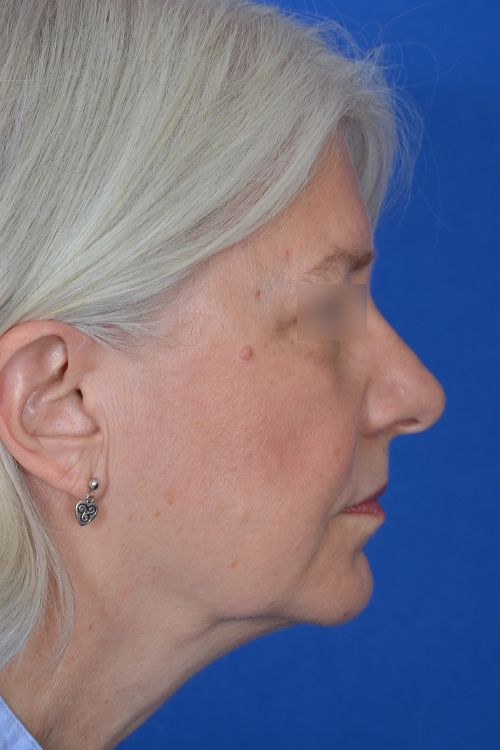 mini facelift before and after