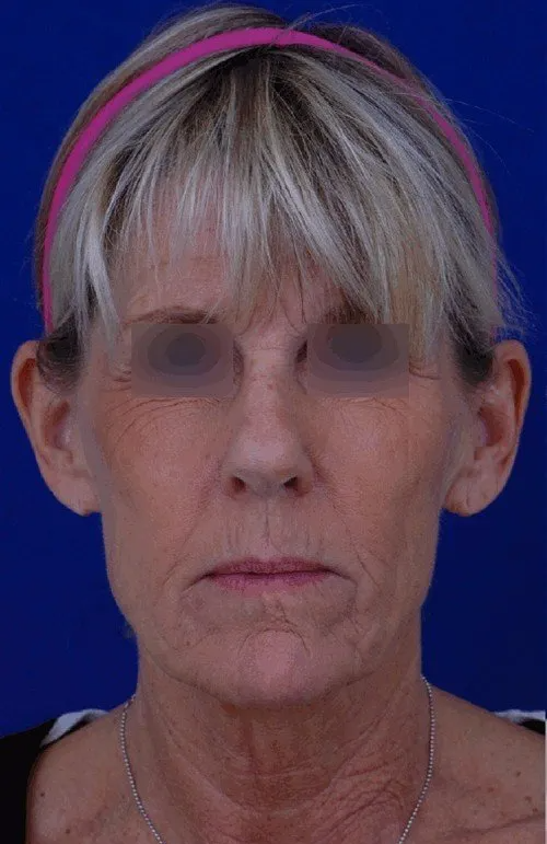 female facelift