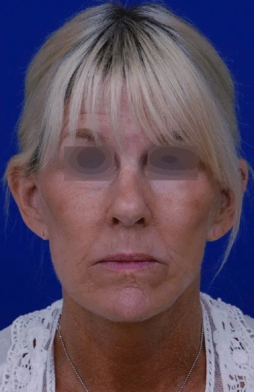 female facelift