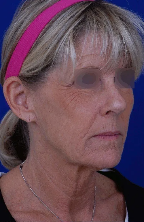 female facelift