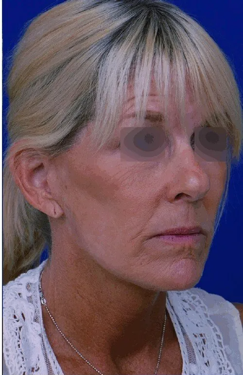 female facelift