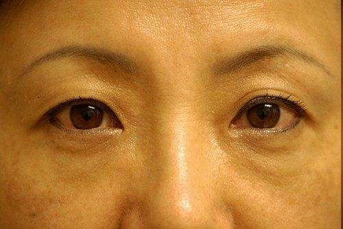 blepharoplasty before and after