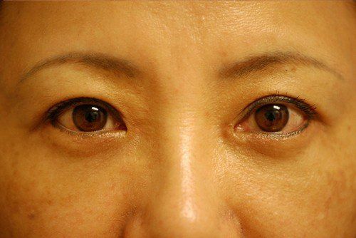 blepharoplasty before and after