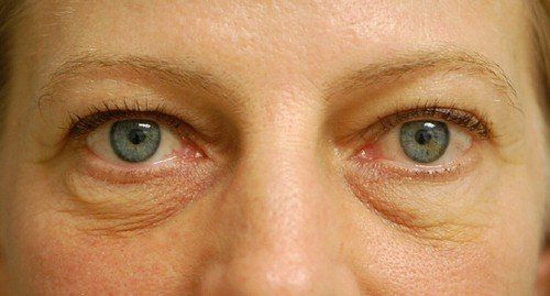 blepharoplasty before and after