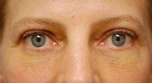 blepharoplasty before and after