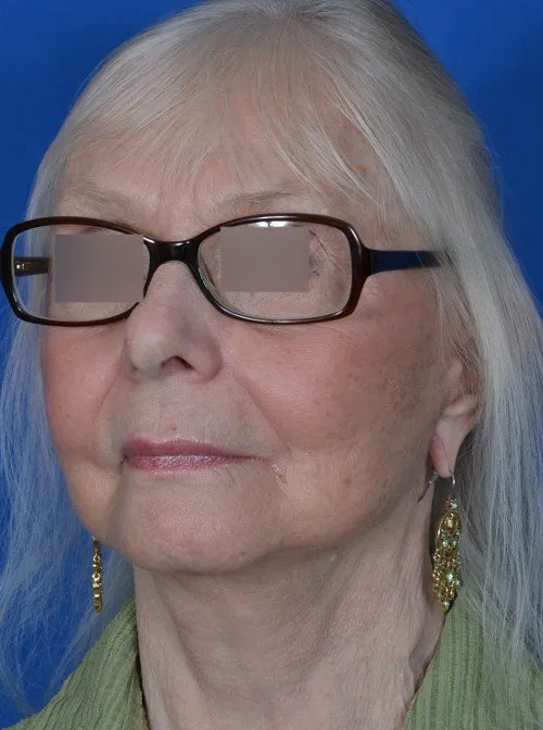 female facelift