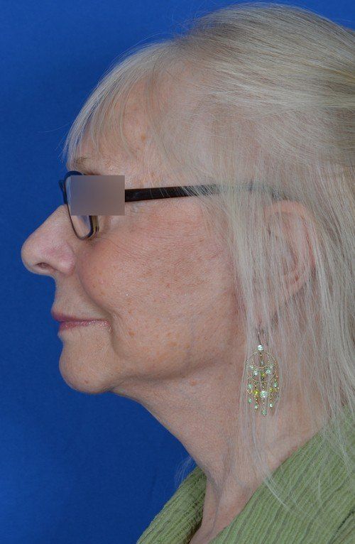 female facelift
