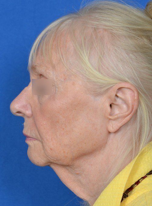 female facelift